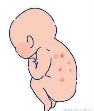 什么是新生儿红斑