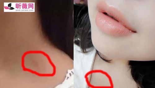 草莓印多久才能消失一小时快速消除草莓印吻痕