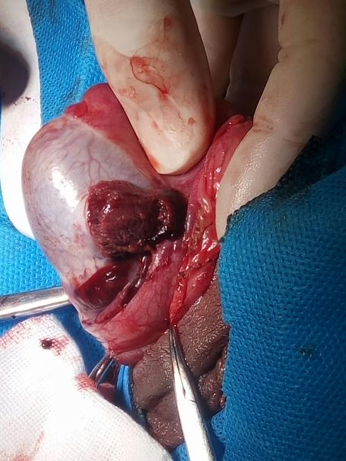 术中见睾丸白膜破裂,睾丸内有大量血块和坏死睾丸组织.