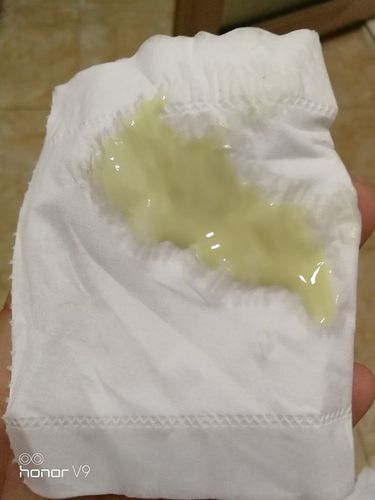 分泌物黄绿色,大家有这样的吗