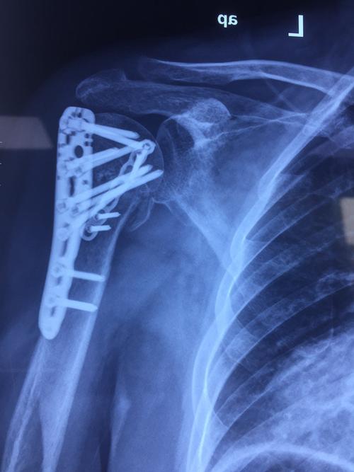 左侧肱骨近端骨折