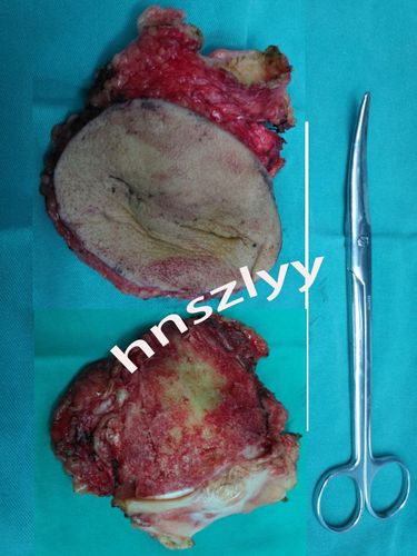 恶性软组织肿瘤彻底切除是减少术后复发的最主要因素; 2.
