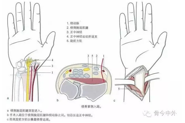 精美图解 | 桡骨远端骨折的掌侧入路和背侧入路