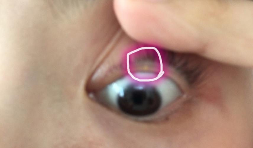 眼睛睫毛根部长的像脂肪粒一样的东西是什么?不痛不痒