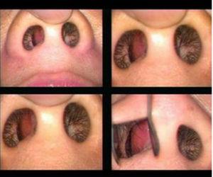 引起鼻功能障碍或产生症状者,均称鼻中隔偏曲(deviation of nasal