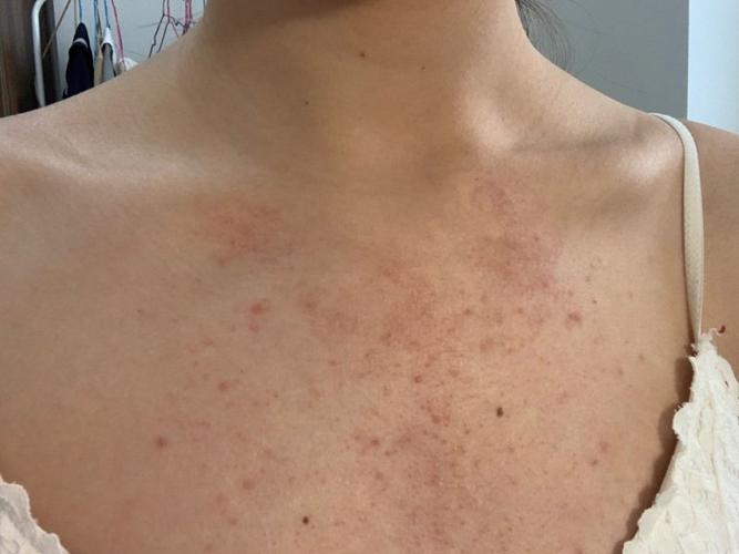 胸口长痘长篇预警!一定要认真看完!(2)