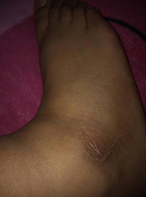 脚踝上不知道怎么出现了这东西,是去年有的.