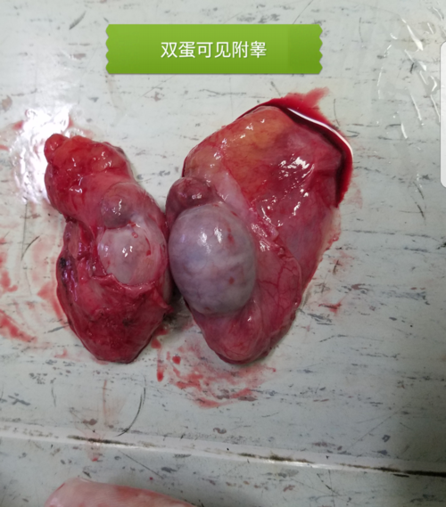 "蛋蛋"知识大全:阴囊痛/睾丸痛