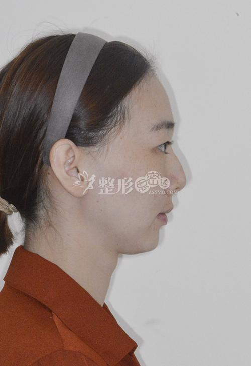 更让人欣喜的是矫正好了牙齿的深覆盖,深覆合问题, 脸型也跟着改变了