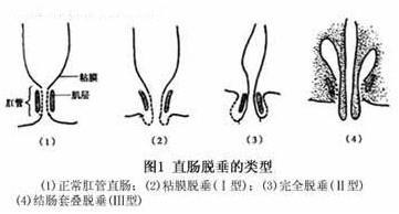 脱肛的症状与危害?脱肛,又称"直肠脱垂",是一种常见的肛肠疾病.