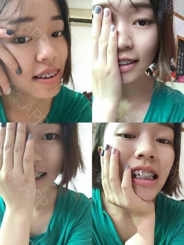 我是属于骨性龅牙,遗传的,其实也不是特别严重,正常状态从正面看也没