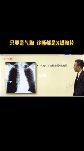 你要是气胸,诊断都是x线胸片_医疗健康_医疗健康其他