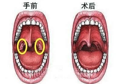 现在小孩为什么得腺样体肥大的那么多