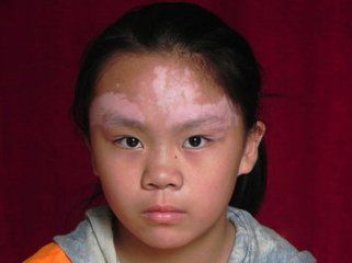 儿童白癜风应该要怎么进行预防