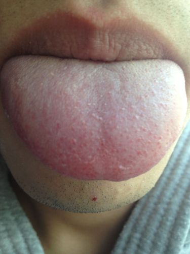 我这是艾滋病舌头症状吗?