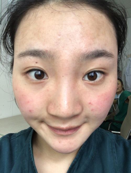 被痘痘激素脸毁容的那些日子