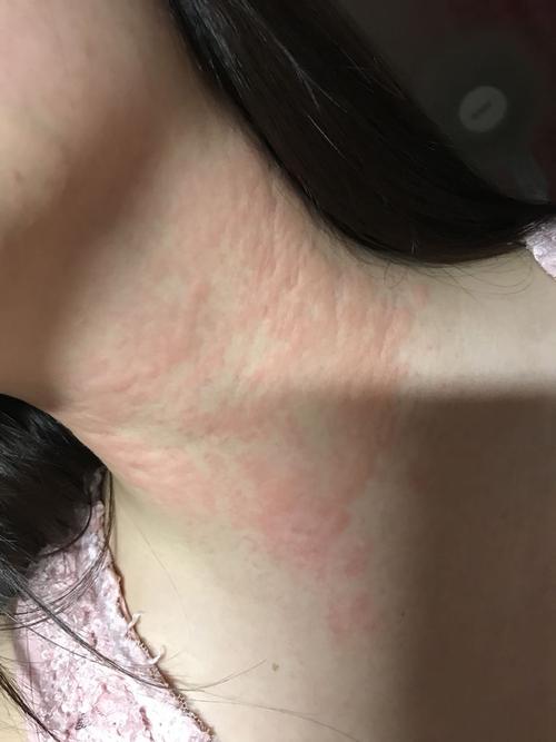 请问脖子上这个是皮炎还是湿疹啊?只有脖子上有,突然起来的,痒痒