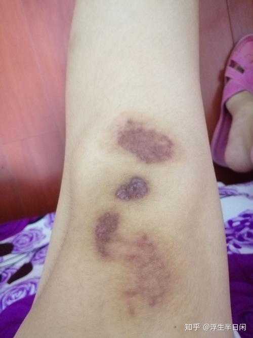 记录膝盖摔伤的康复情况