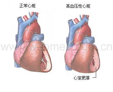 高血压性心脏病的鉴别诊断