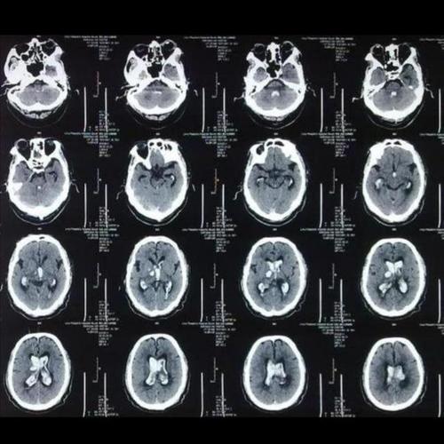 亲身经历家人脑出血看看我是怎么办的