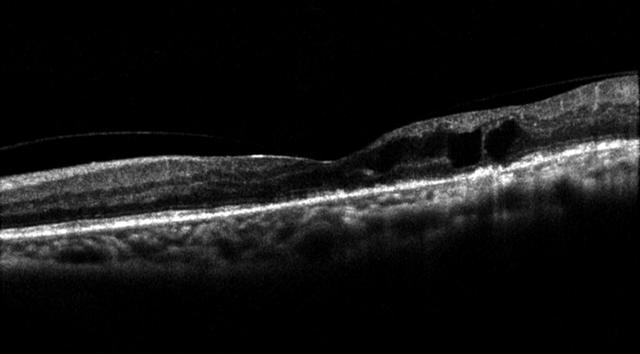 眼底黄斑水肿的oct表现