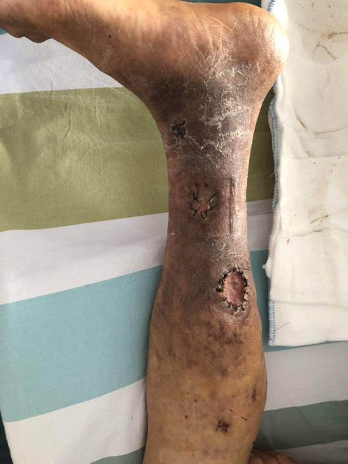 下肢静脉曲张伴溃疡:临床分期为6期,俗称"老烂腿".以上均需手术治疗.