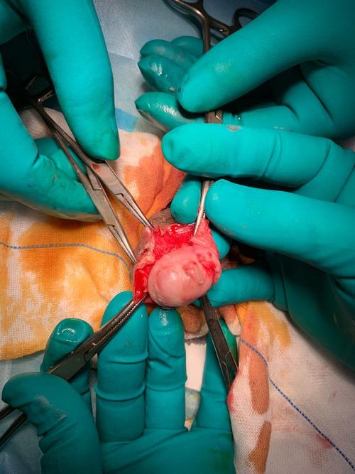 近日做一例复杂包皮环切手术,患者为一70岁男性