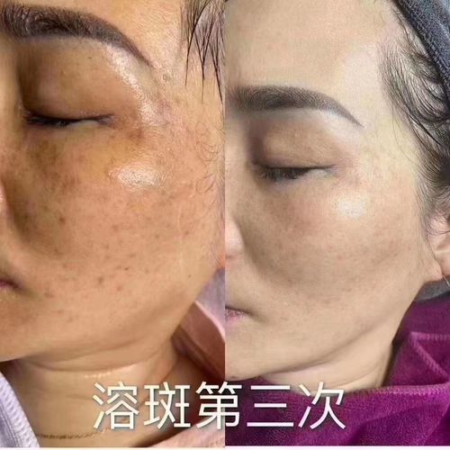 溶斑术祛去斑真皮斑黄褐斑雀斑晒斑微晶分解色黑素淡化斑点溶斑液