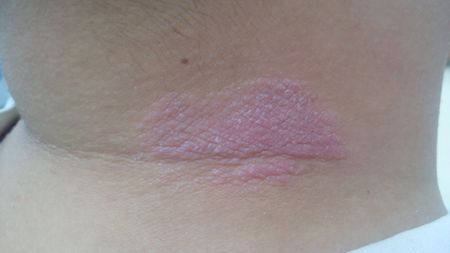 问:脖子上长了个东西,痒,请问这是皮炎还是癣?