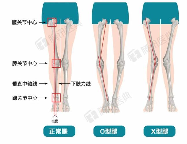 比如下面这张图: 正常情况下,下肢力线(通过髋关节中心,膝关节中心和
