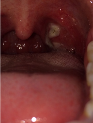 为什么我的扁桃体上会有一大片白色的东西,而且喉咙很