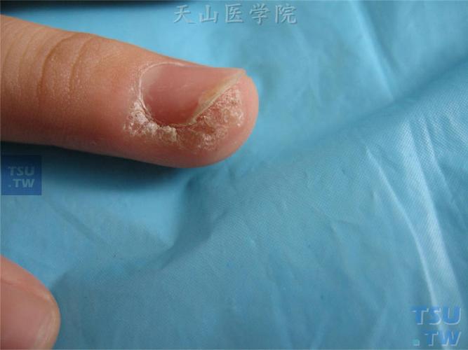 甲周疣或甲下疣是发生于甲板下或甲廓部位的寻常疣,因部位特殊,易发生