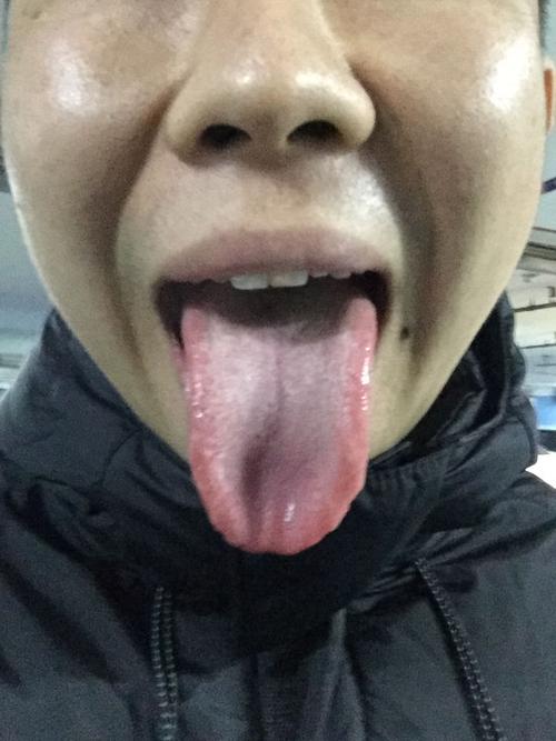 专家给看看舌头,身体出现了什么问题,是白色念球菌吗?