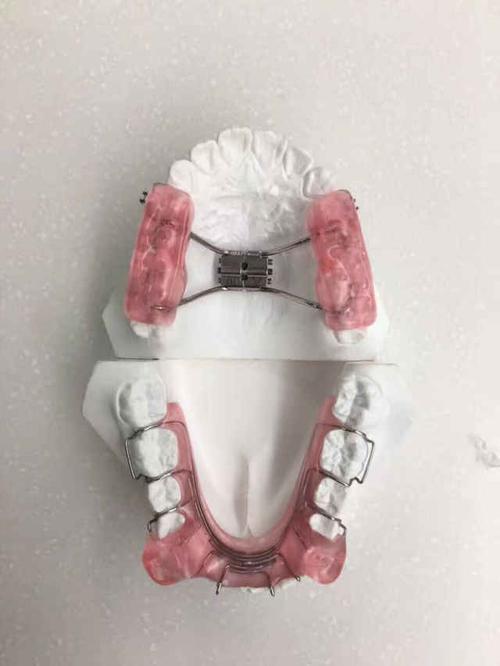 下巴后缩矫正后,整牙堪比整容