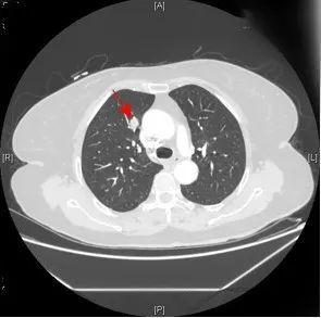 ct显示右肺肿瘤