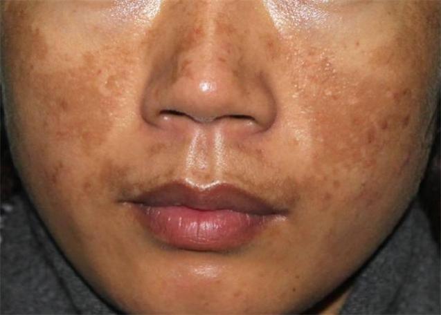 44岁大姐一脸斑,每天用蛋清淡斑,5个月后结果很意外