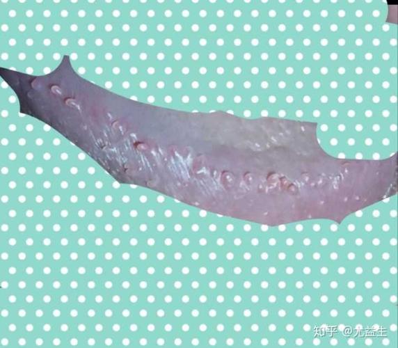 膜样改变,但是 假性湿疣颗粒分布比较均匀,也没有明显的菜花状的隆起