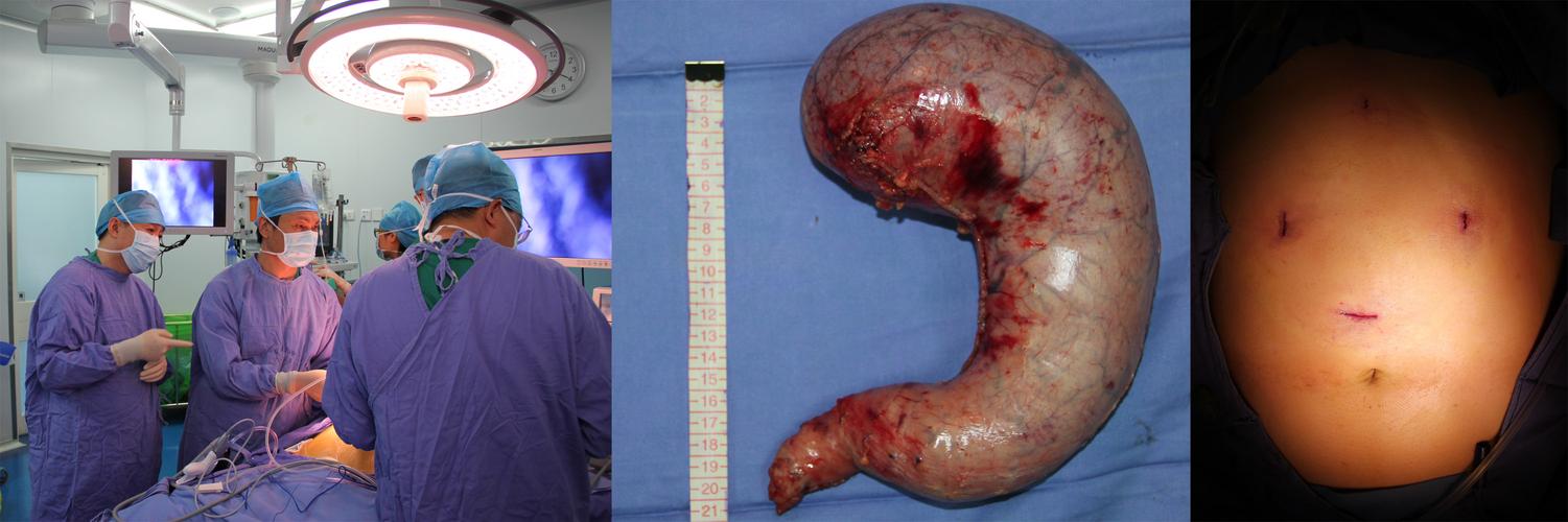 瘦身先瘦胃,肥胖患者的"封口"技术—— 腹腔镜胃袖状切除术