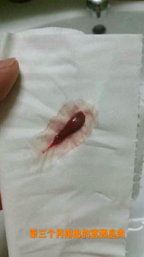 宫颈息肉病例—4个月痊愈