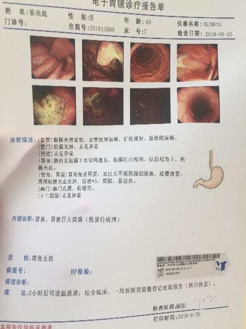 胃角侵及胃窦,见巨大不规则深凹溃疡,底覆浊苔,周围粘膜充血水肿,活检