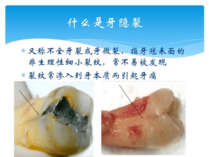 牙隐裂ppt