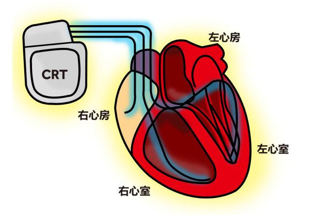 是不是安了心脏起搏器就能救命?