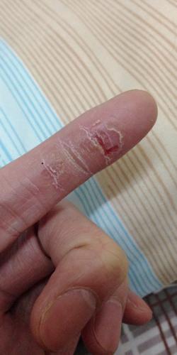 这只手指干裂得很.不痕痒但会痛.只要把干裂啲皮撕掉就会很痛.