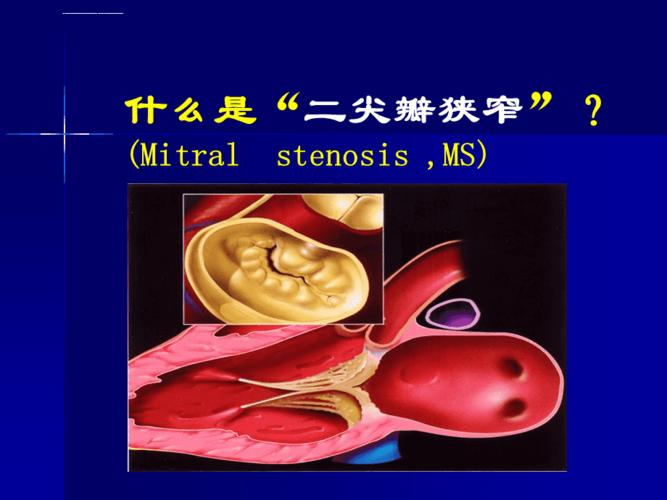 二尖瓣狭窄之诊治ppt课件