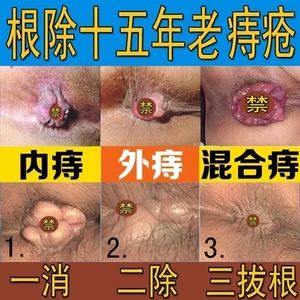 治疗脱肛的药痔根断进口正品女痔疮药膏外痔内痔痔疮药肛裂愈合膏