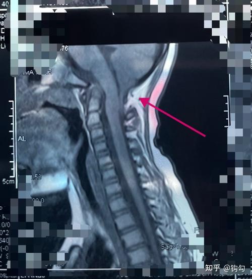 ct测出来是腰椎间盘突出0.3厘米,准确吗?会有可能是膨出吗?能不能?