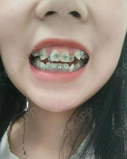 金属托槽矫正手术当天_牙齿矫正手术当天_牙齿美容手术当天_雾以泪聚