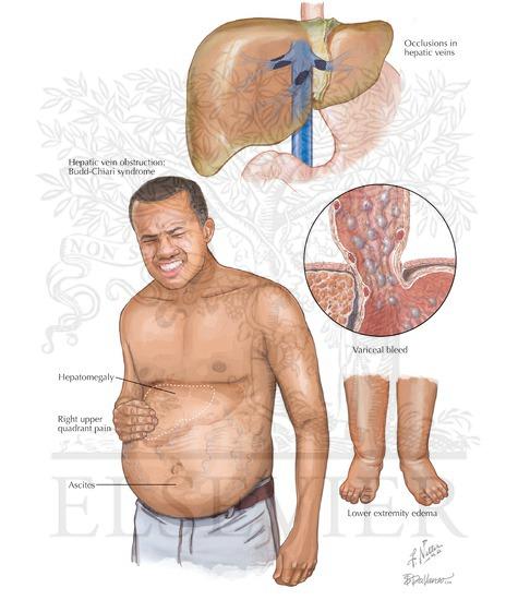 腹水,胃底静脉曲张,下肢水肿