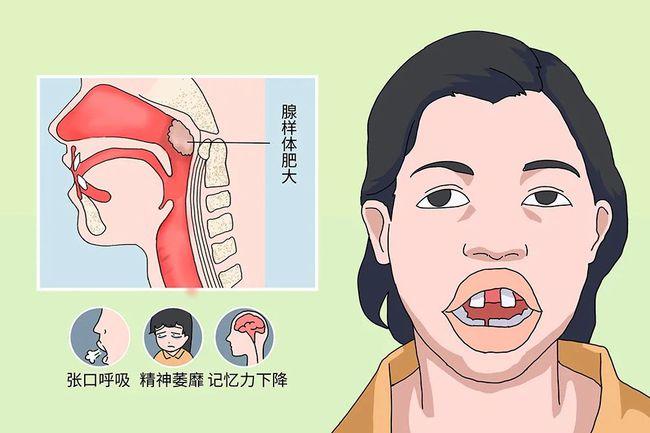 孩子腺样体面容几乎不可逆!其实,这些症状都是腺样体肥大在作怪