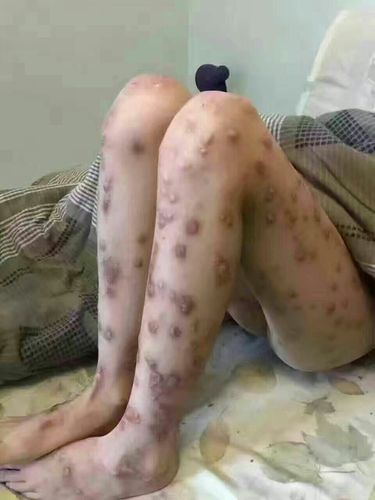 重度特应性皮炎好转分享